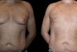 Before and After Male Breast Reduction Results