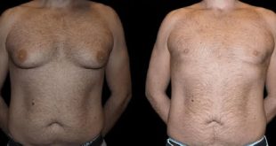 Before and After Male Breast Reduction Results