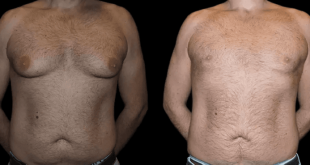 male breast reduction in dubai