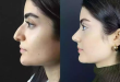 The Rise of Nose Surgery: Trends in Dubai