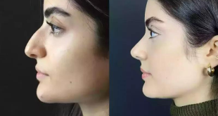 The Rise of Nose Surgery: Trends in Dubai